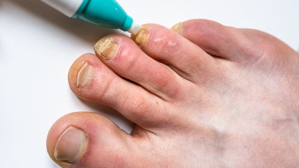 fungal nail infection