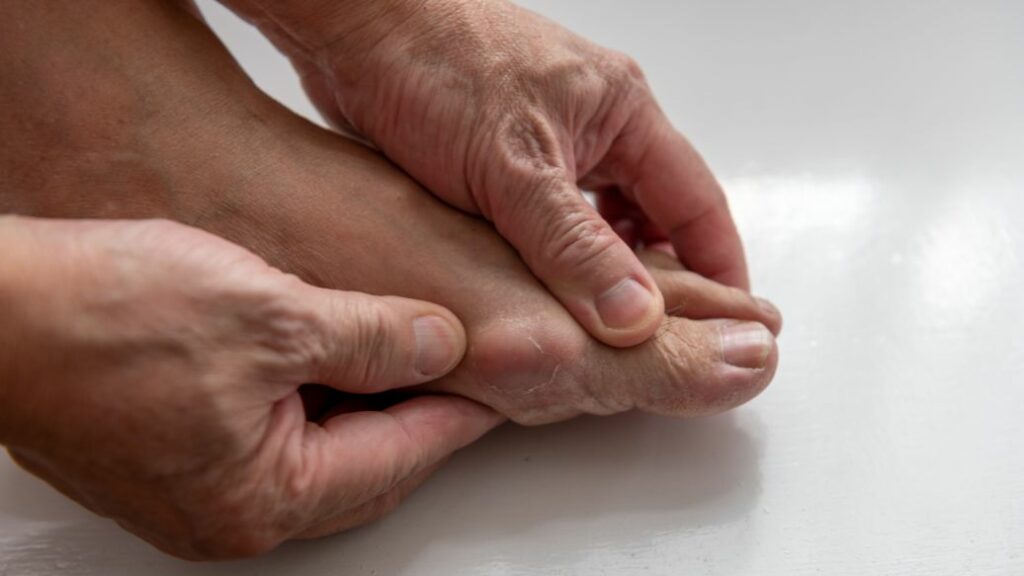 gout treatment